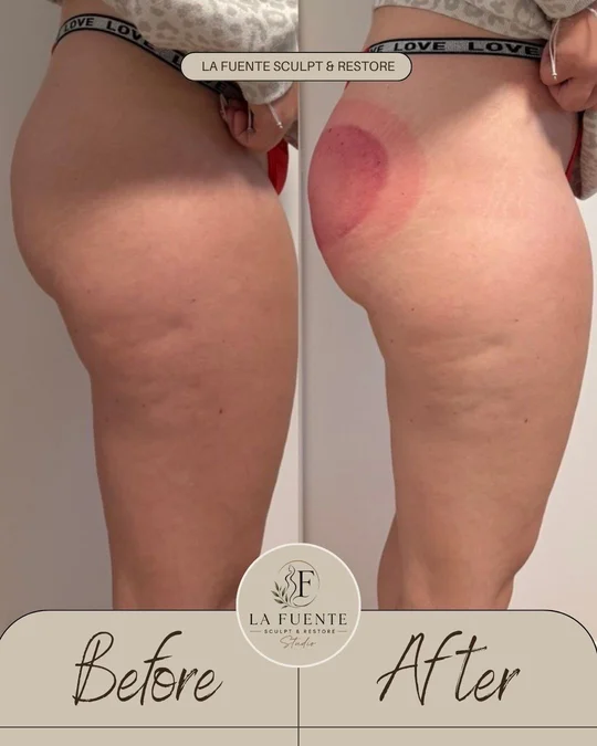 Side-by-side client photos labelled before and after a booty-plump appointment.