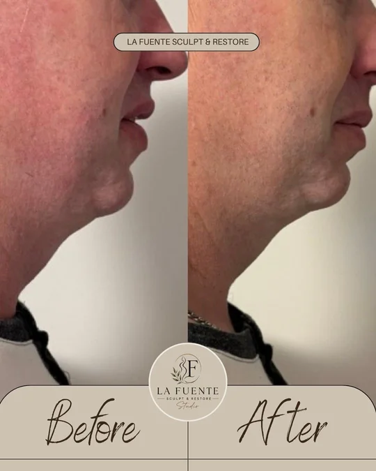 Side-profile client photos labelled before and after a jawline appointment.