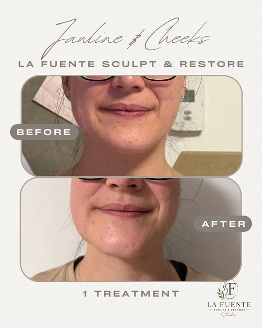 Client photo collage showing front views labelled before and after a jawline and cheek appointment.