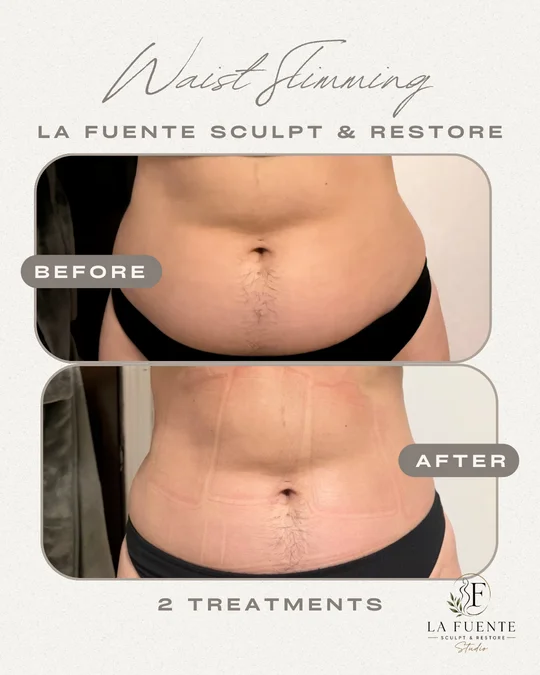 Client photo collage showing the waist, labelled before and after two treatments.
