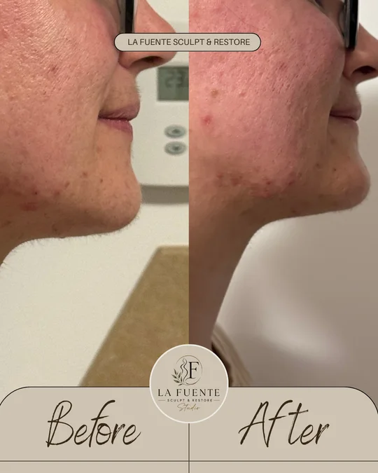 Side-profile client photos labelled before and after a jawline and cheek appointment.