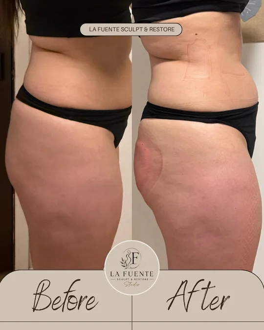 Side-view client photos labelled before and after a waist-contouring appointment.