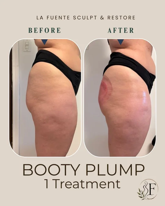 Side-view client photo collage labelled booty plump, one treatment, before and after.