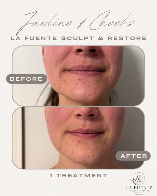 Front-view client photos labelled before and after one jawline and cheek treatment.