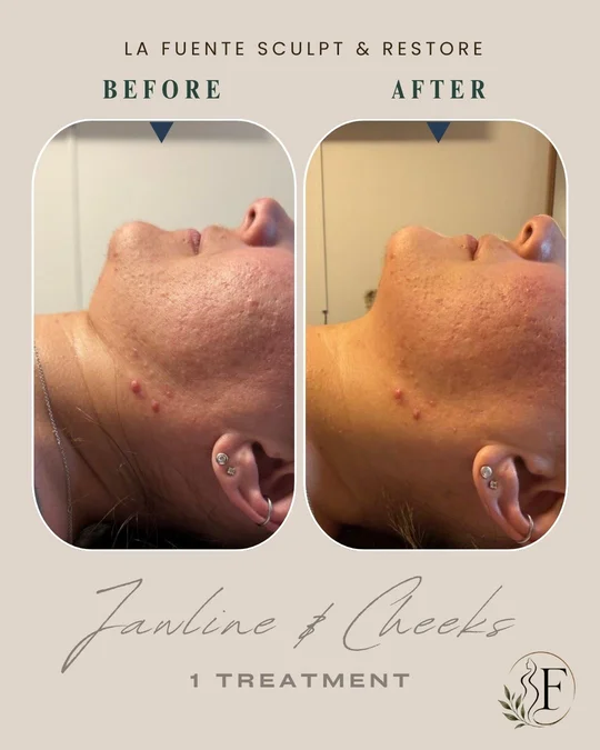 Client photo collage showing profile views labelled before and after one jawline and cheek treatment.