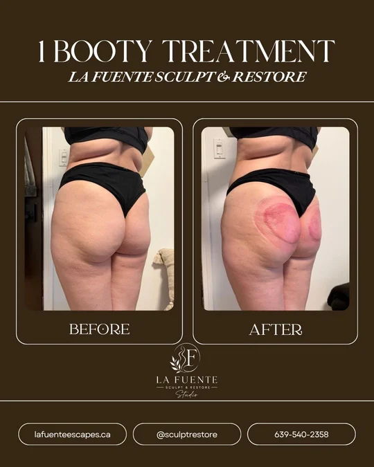 Rear-view client photos labelled before and after one booty treatment.