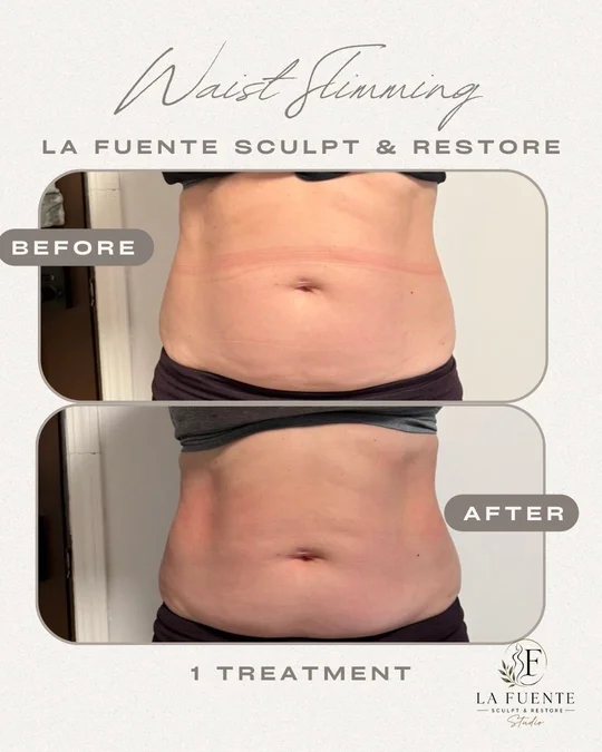 Front-view client photos labelled before and after one waist-contouring treatment.