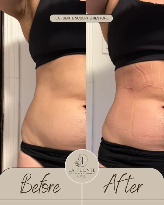 Side-view client photos labelled before and after a waist-contouring appointment.