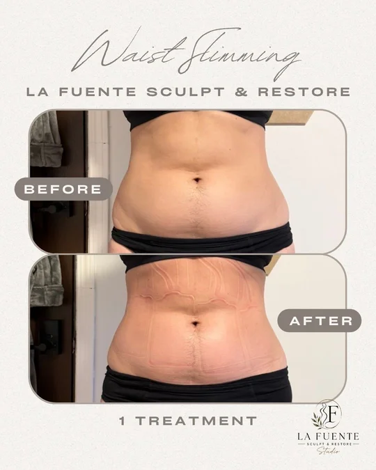 Front-view client photo collage labelled before and after one waist-contouring treatment.
